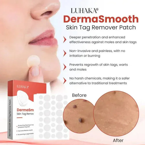DermaSmooth Skin Tag Remover Patch – Fast, Safe, And Painless Skin Tag And Mole Removal Solution With No Scarring Or Pigmentation0